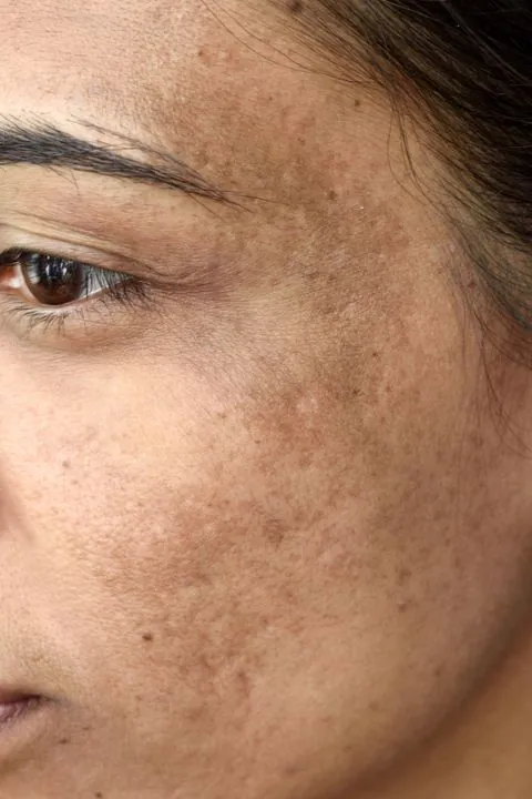 Close-up of pigmentation and melasma on a woman's cheek