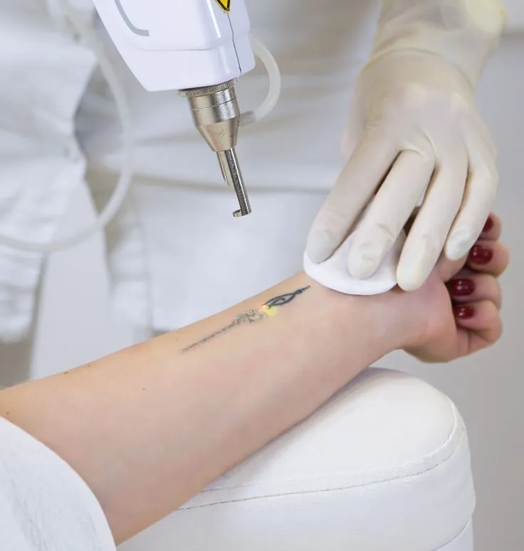 Laser tattoo removal on a forearm